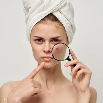 IPL Acne
