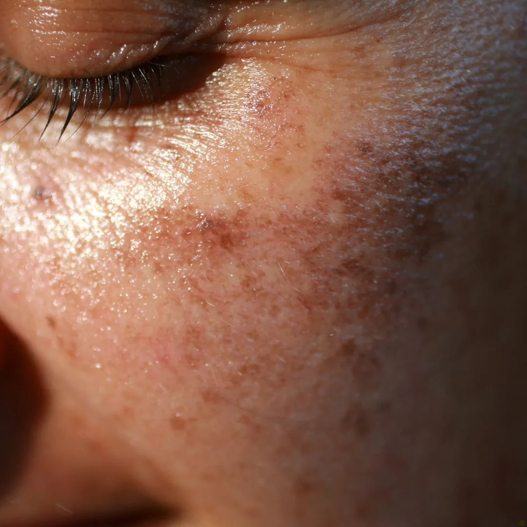 Hyperpigmentation